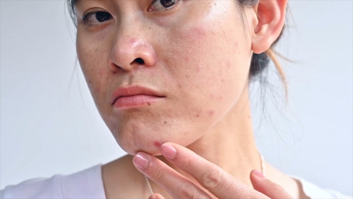 Mụn trứng cá là một vấn đề da liễu