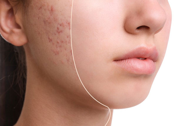 điều trị các loại mụn “khó nhằn”