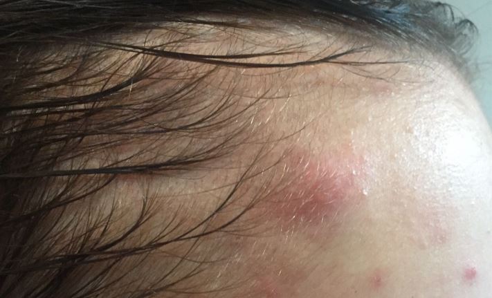 Mụn nổi ở chân tóc