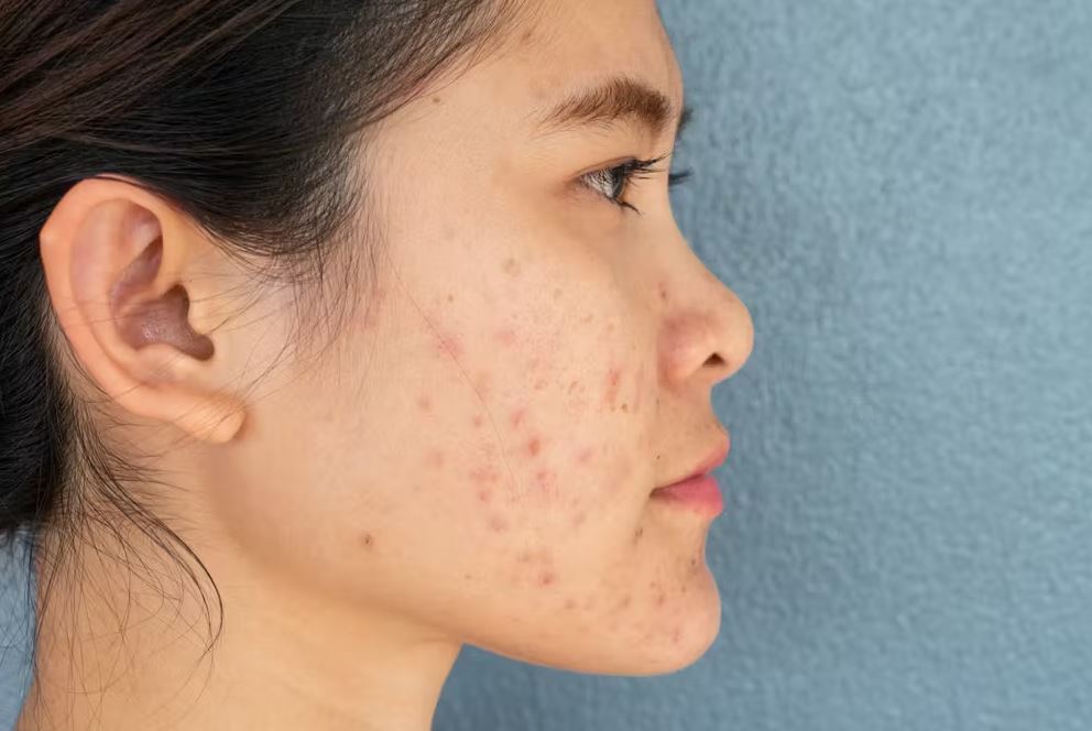 Mụn nổi trên má