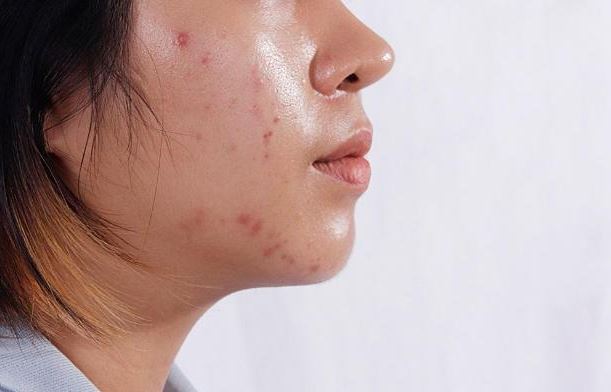 da bạn luôn đổ dầu
