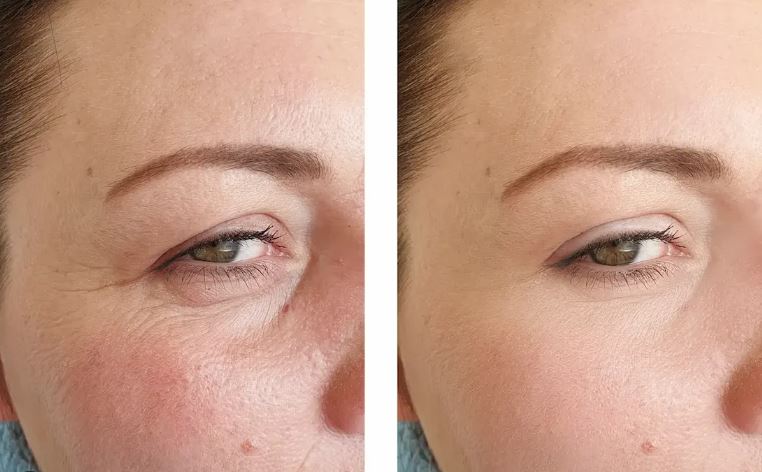 Ảnh điều trị trước và sau sử dụng Retinol Complex A+