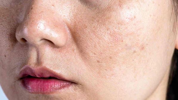 LÀN DA CHÚNG TA MẤT NƯỚC