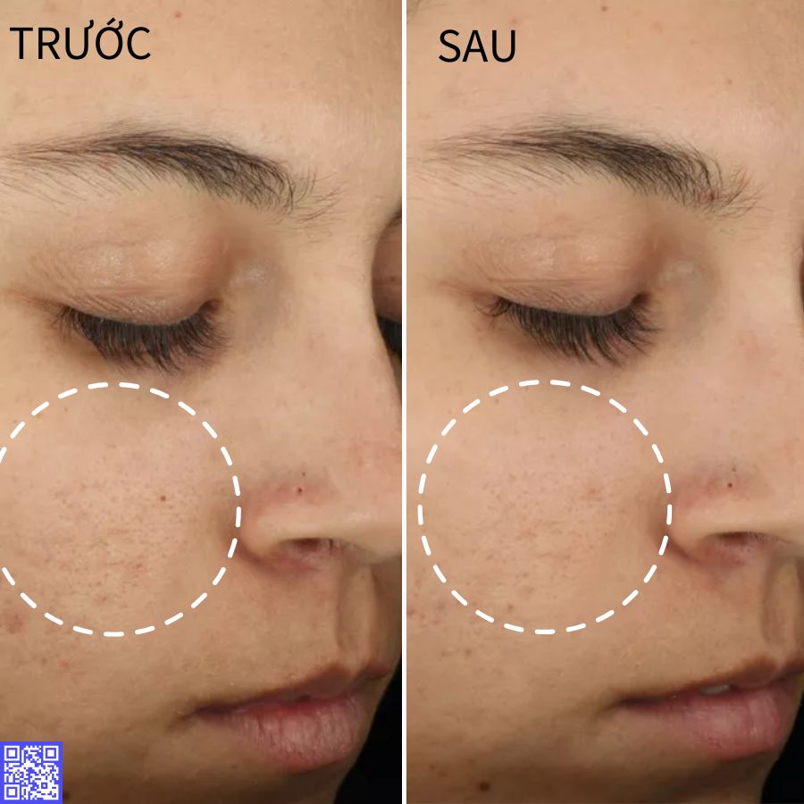 chăm sóc da dầu mụn vói Zo Skin Health