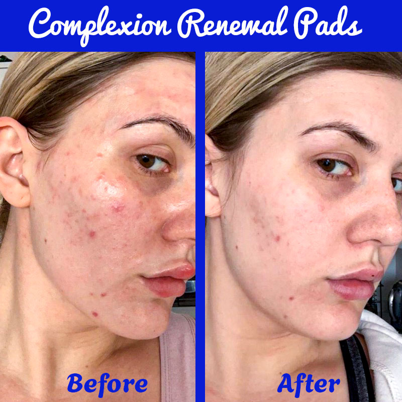 Hình trước sau khi sử dụng Complexion Renewal Pads