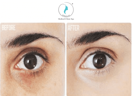 Hiệu quả trước và sau khi sử dụng Obagi Medical Elastiderm Eye Serum
