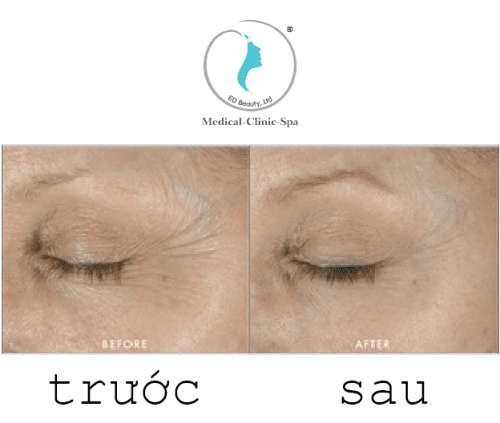 Hiệu quả trước và sau khi dùng Obagi Medical ELASTIderm Eye Cream