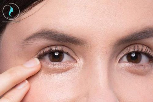 Bọng mắt khiến gương mặt kém sức sống