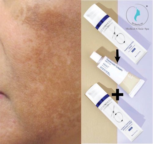 Bộ Zo Skin Health Pigment khắc phục nám da