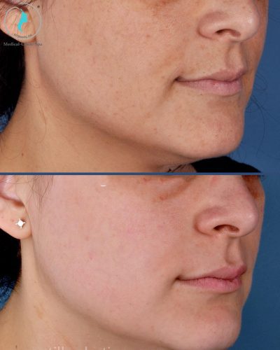 Hiệu quả trước sau khi dùng bộ ZO Skin Brightening Program + Texture Repair