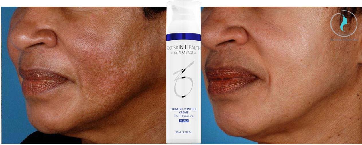 LIỆU TRÌNH ZO PIGMENT 4 HYDROQUINONE ĐẶC TRỊ DA NÁM TÀN NHANG