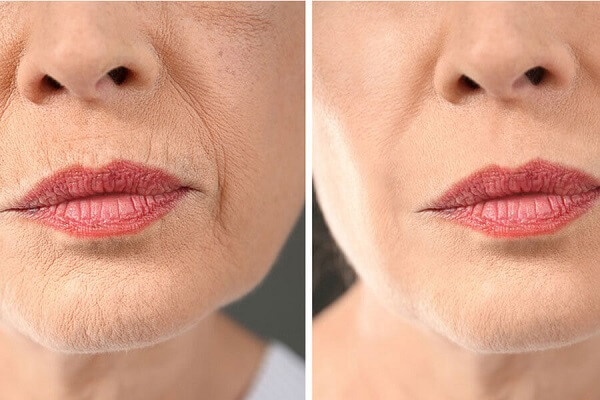 Da lão hóa nám, chảy xệ