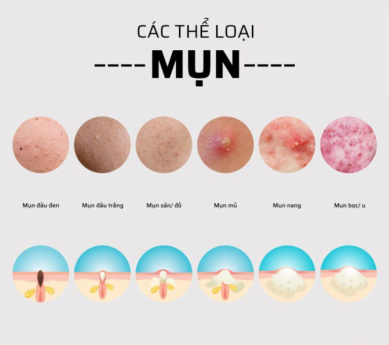 Có bao nhiêu loại mụn?