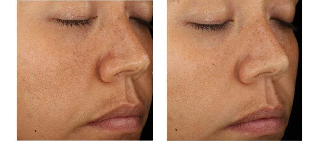 Ảnh trước sau khi sử dụng cặp đôi