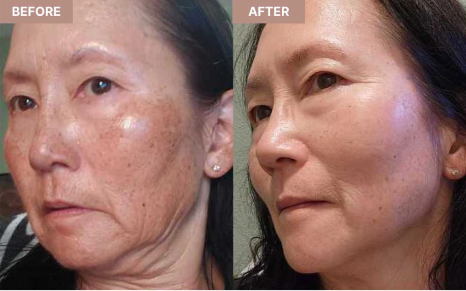 Hình: Trước và sau khi sử dụng Padagis Tretinoin