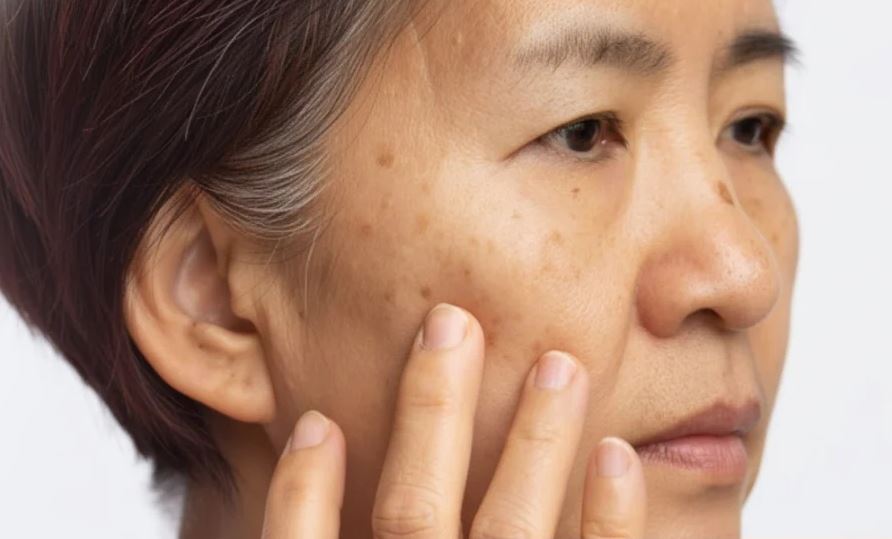 Hình: BẠN TỰ TI DO NẾP NHĂN HAY ĐỐM NÂU